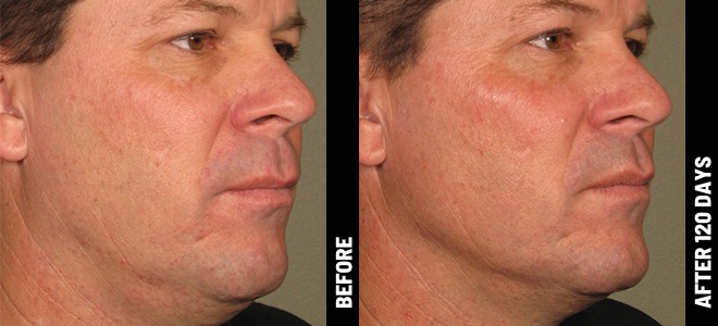 Ultherapy Before and After - Result 1