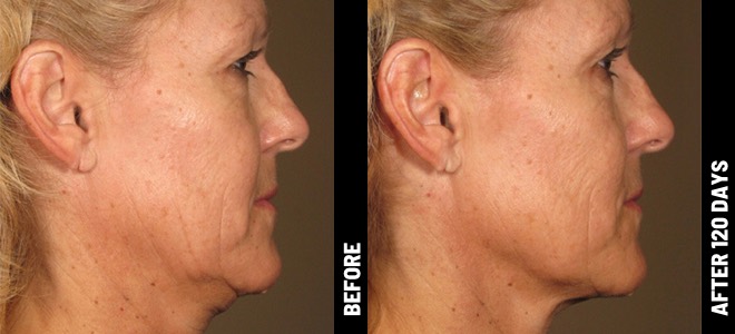 Ultherapy Before and After - Result 2