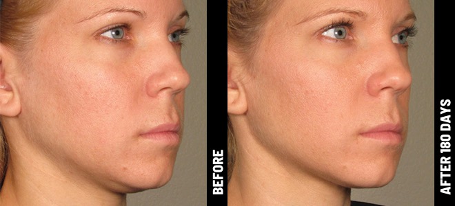 Ultherapy Before and After - Result 3