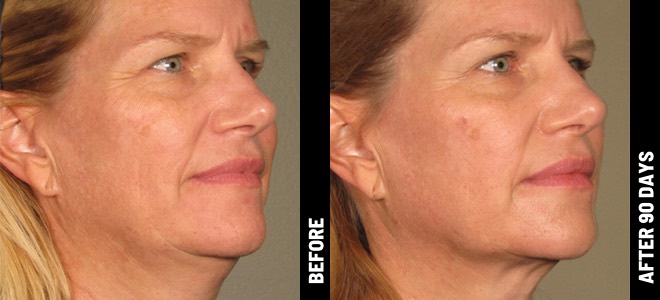 Ultherapy Before and After - Result 4