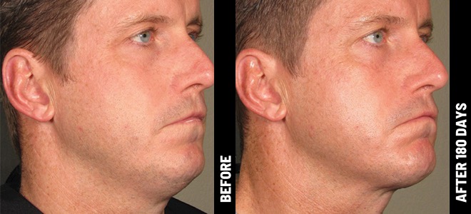 Ultherapy Before and After - Result 5