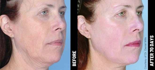 Ultherapy Before and After - Result 6