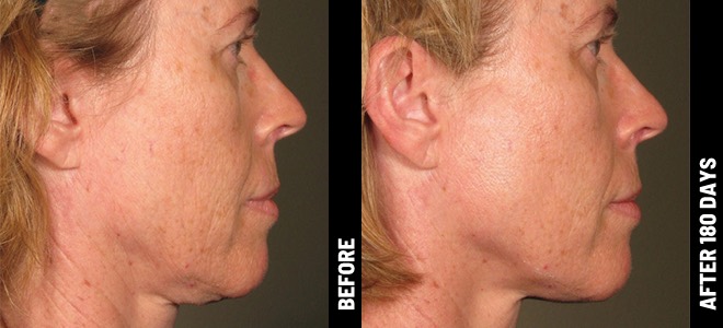 Ultherapy Before and After - Result 7