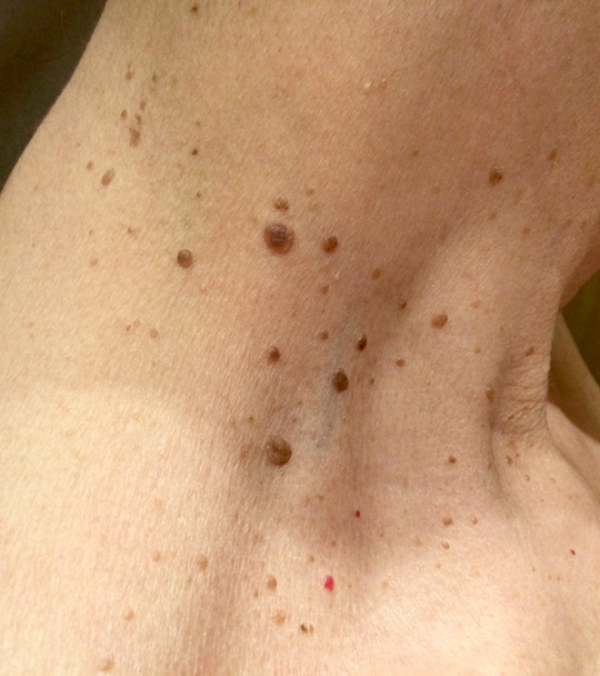 Clinical example of skin tags