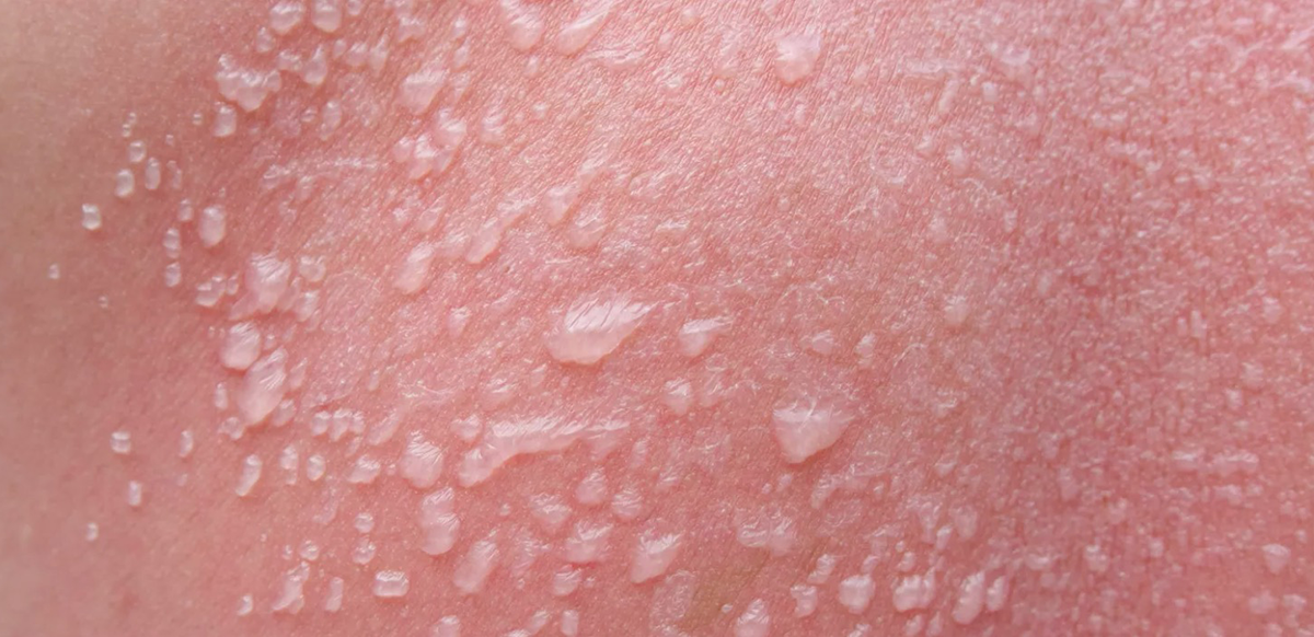 Blistering skin condition