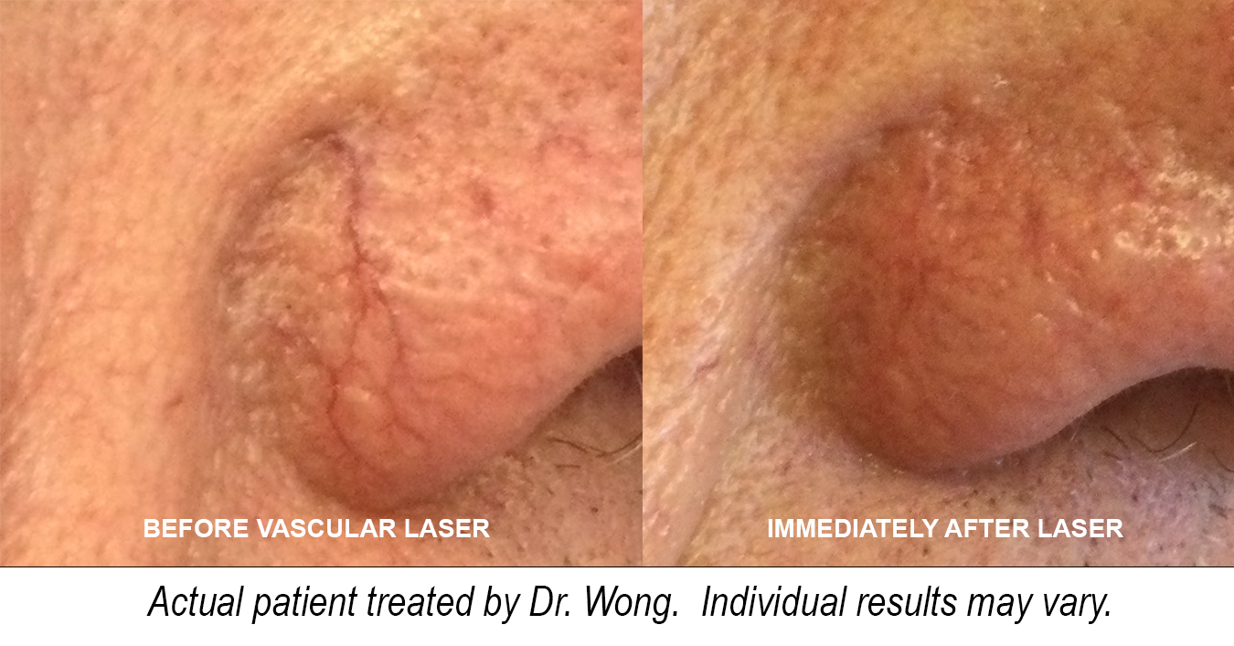 Before and immediately after vascular laser treatment - Actual patient treated by Dr. Wong