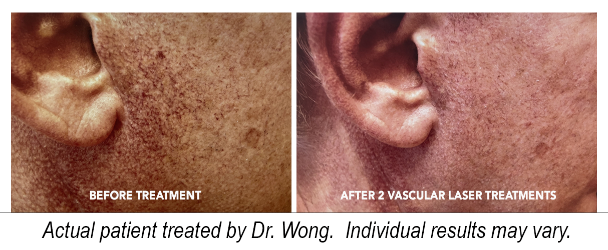Before treatment and after 2 vascular laser treatments - Actual patient treated by Dr. Wong