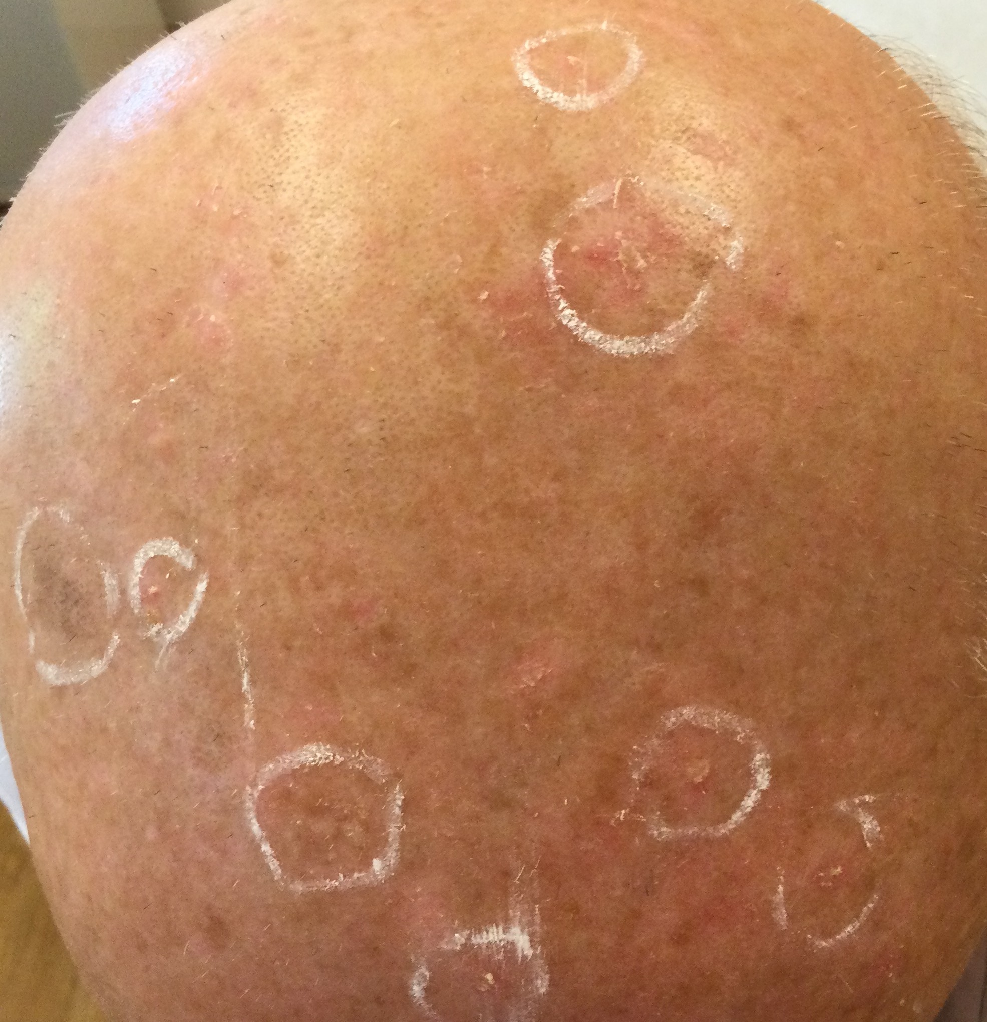 Precancer of the scalp