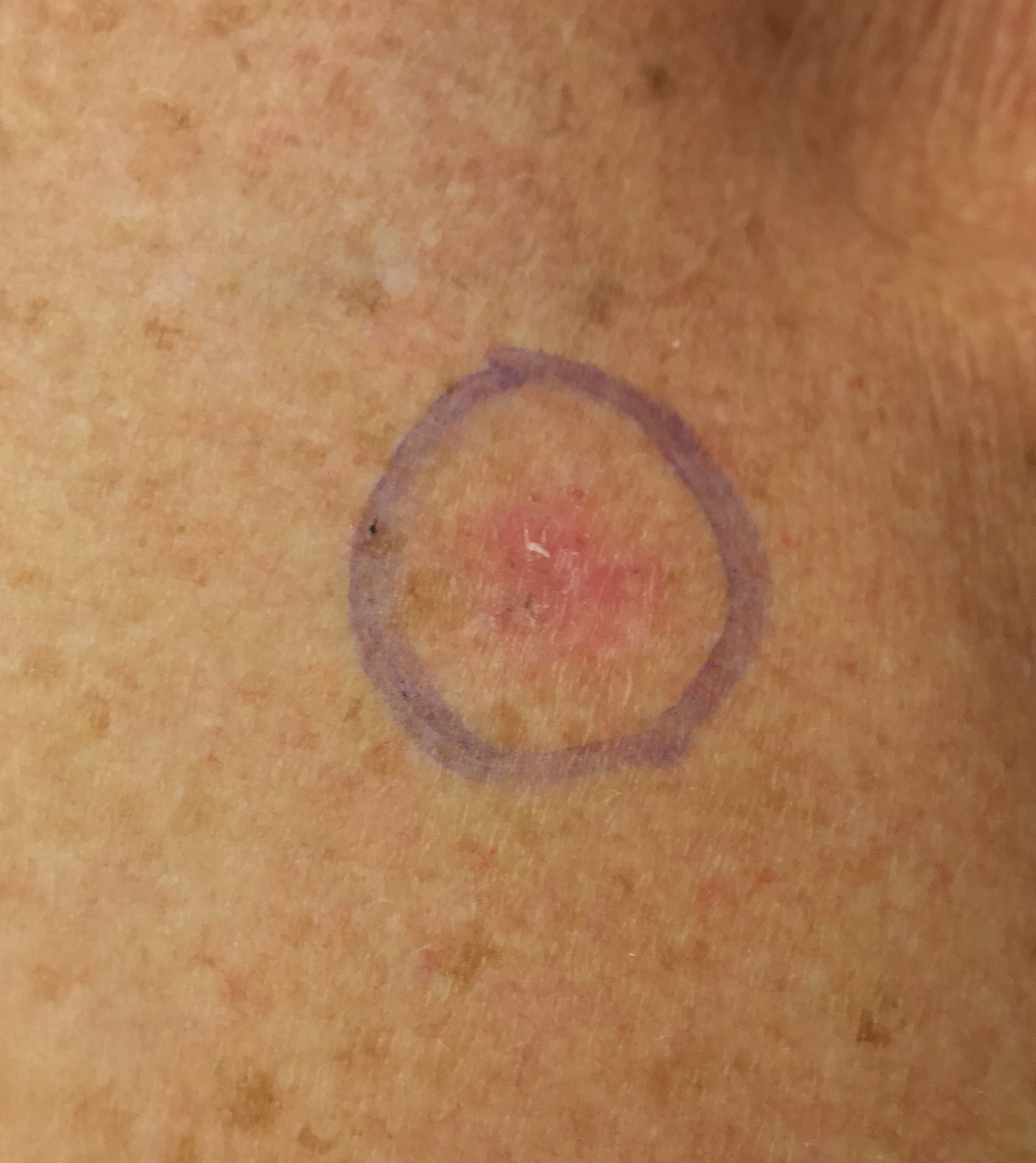 Basal cell carcinoma on chest