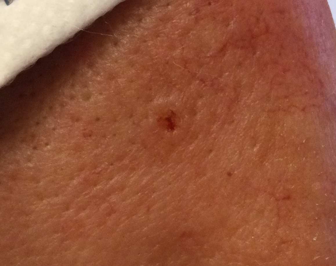 Basal cell carcinoma NOT pimple