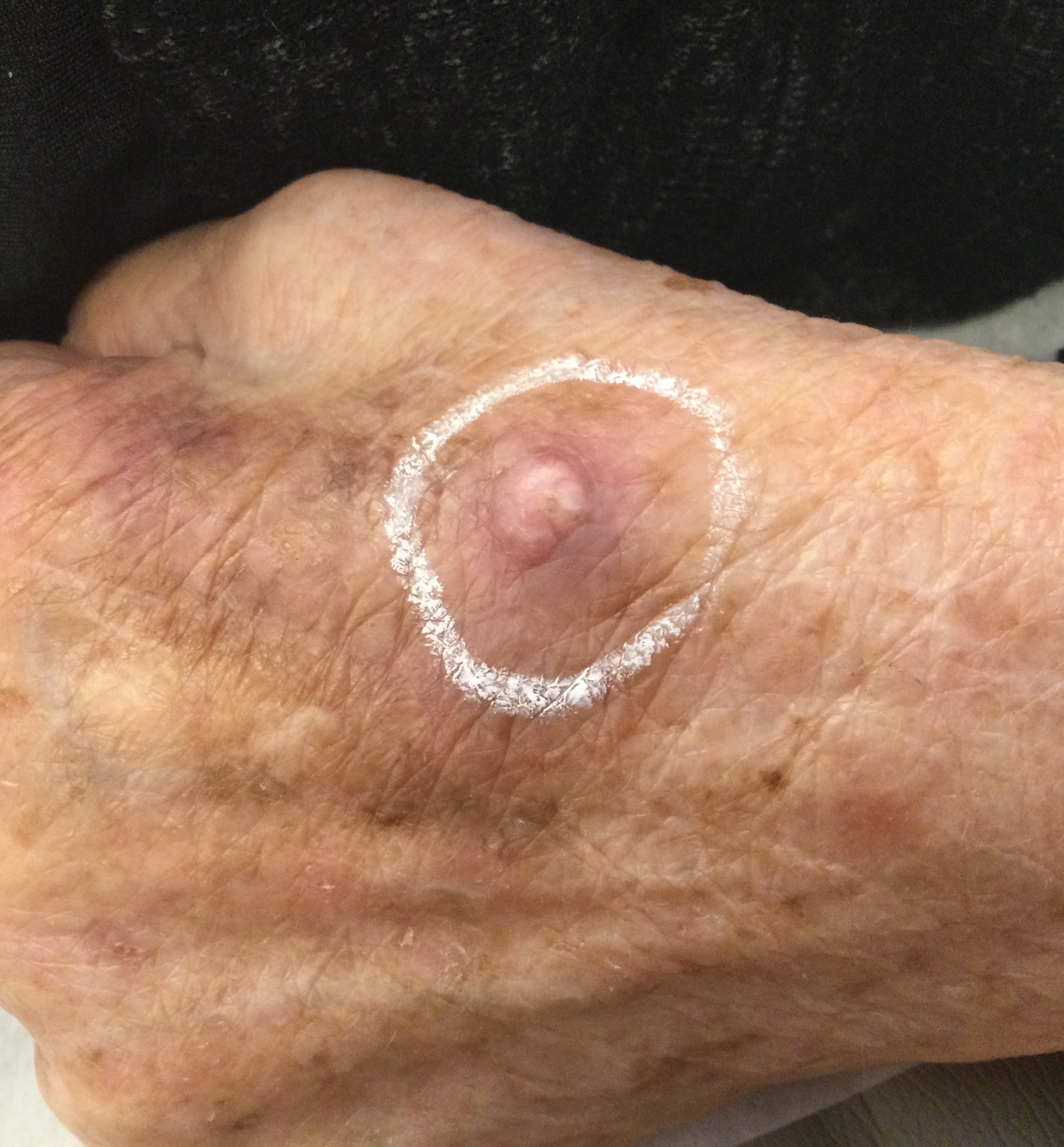 Squamous Cell carcinoma on Hand
