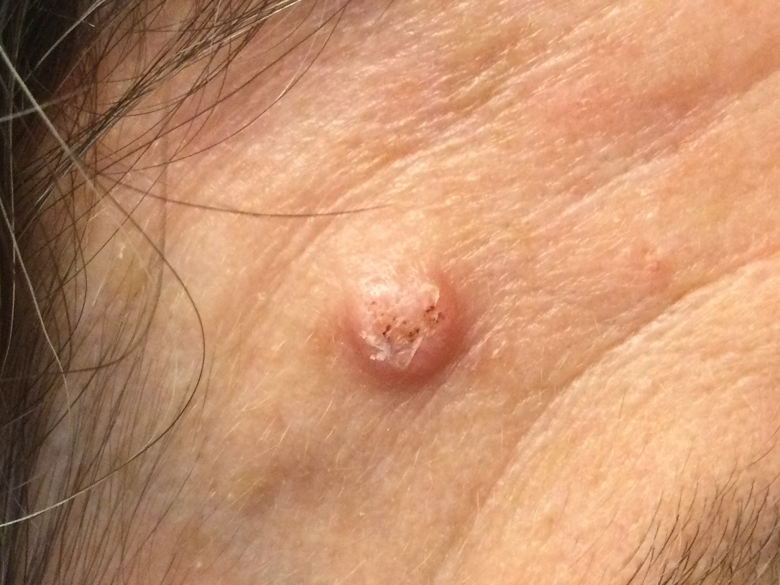 Squamous Cell carcinoma