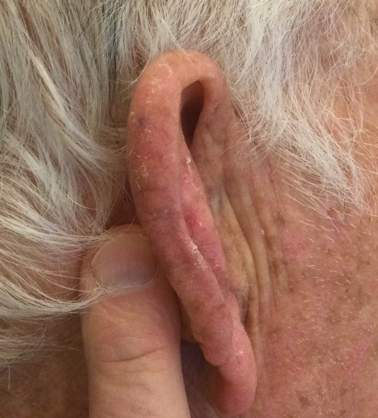 Precancerous growth on Ear