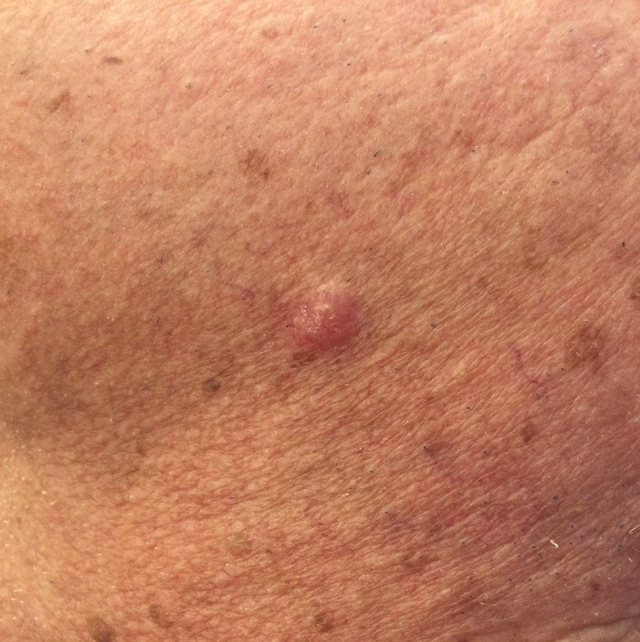 Basal cell carcinoma