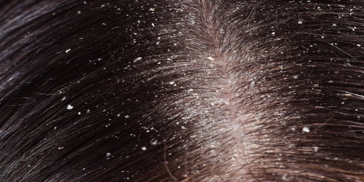 Dandruff on scalp