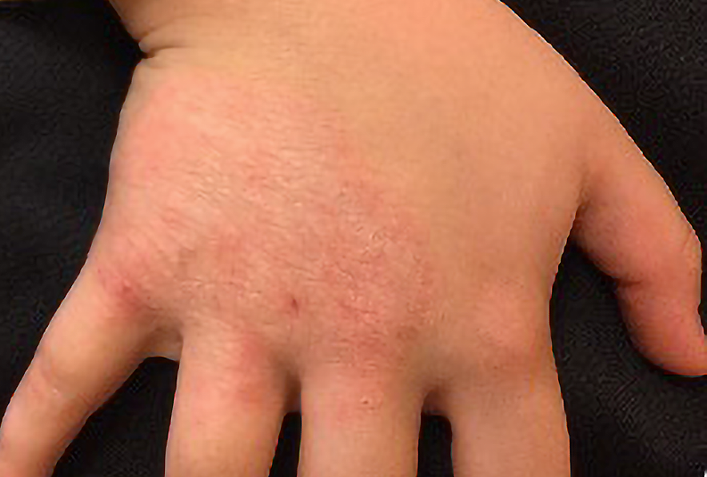 Eczema on hand