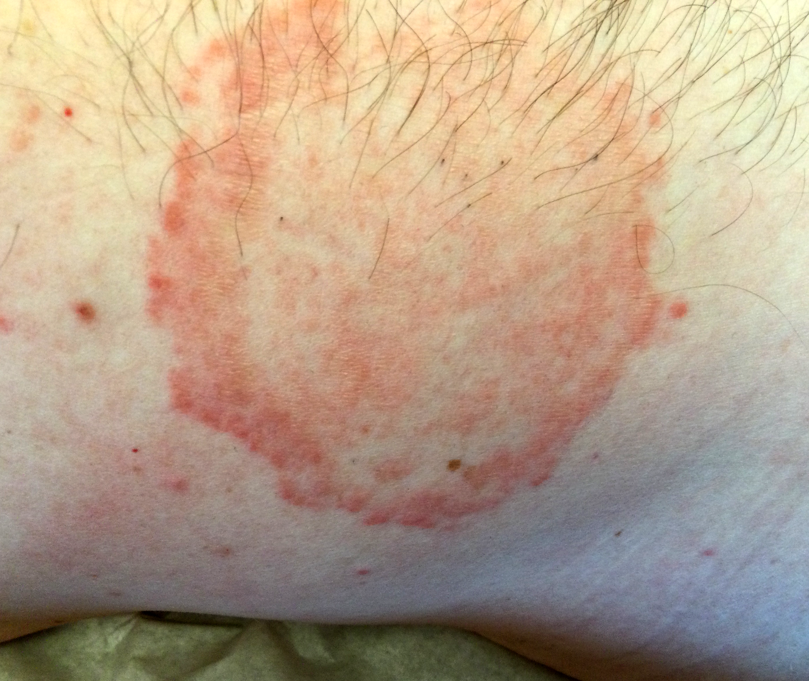 Fungal infection on skin