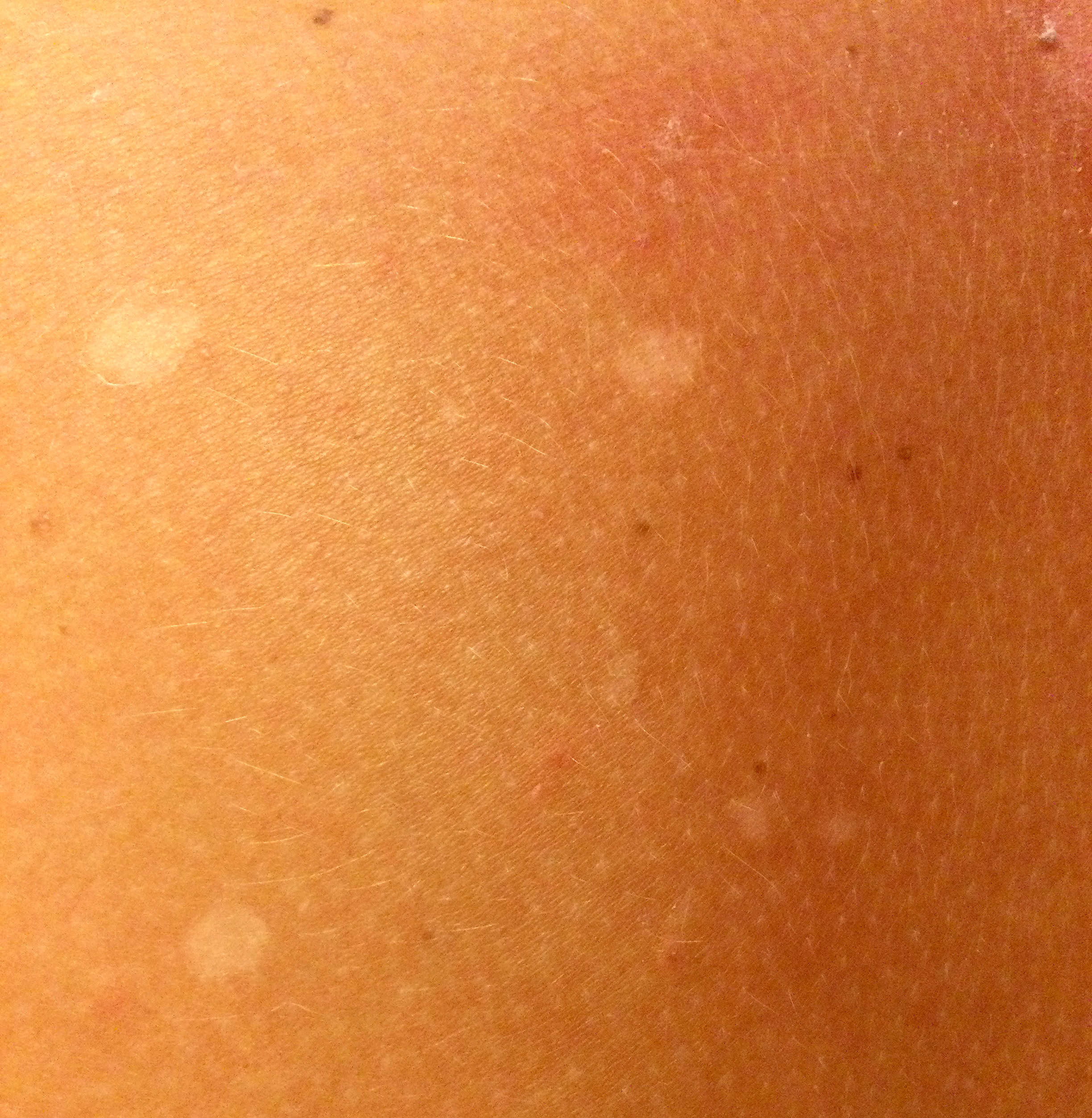 Fungal infection showing discoloration