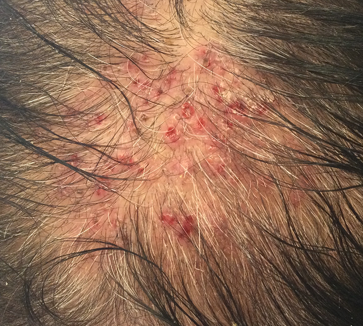 Fungal infection on scalp