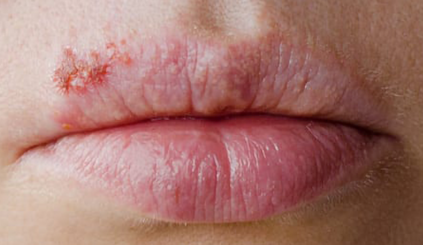 Herpes lesion on lip