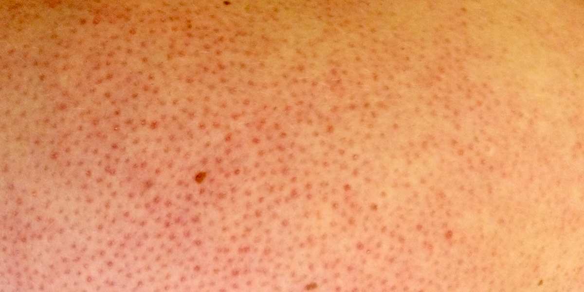Keratosis pilaris showing characteristic bumpy skin texture