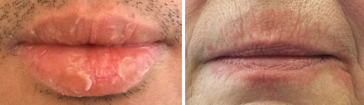 Examples of lip disorders showing various conditions