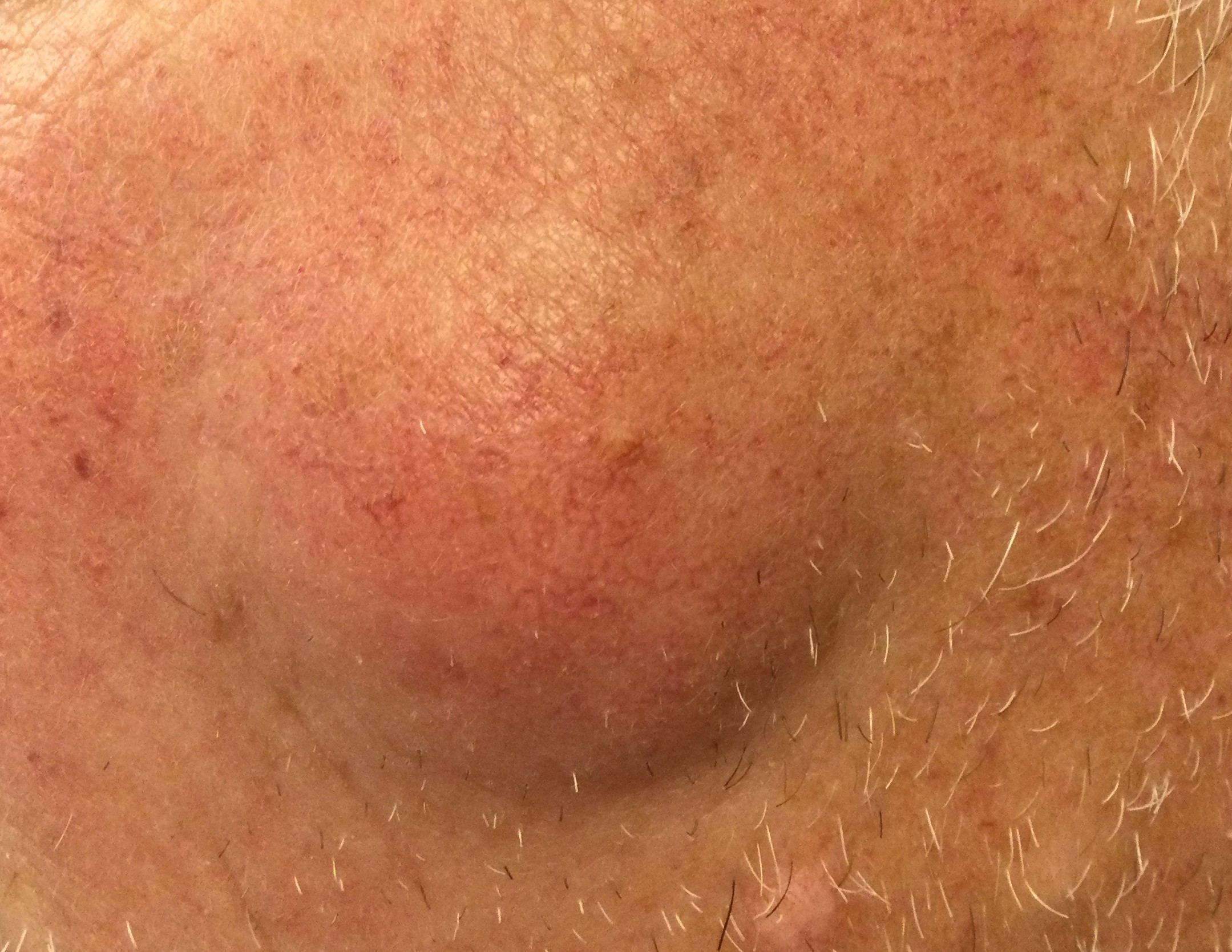 Example of skin lump or bump requiring evaluation