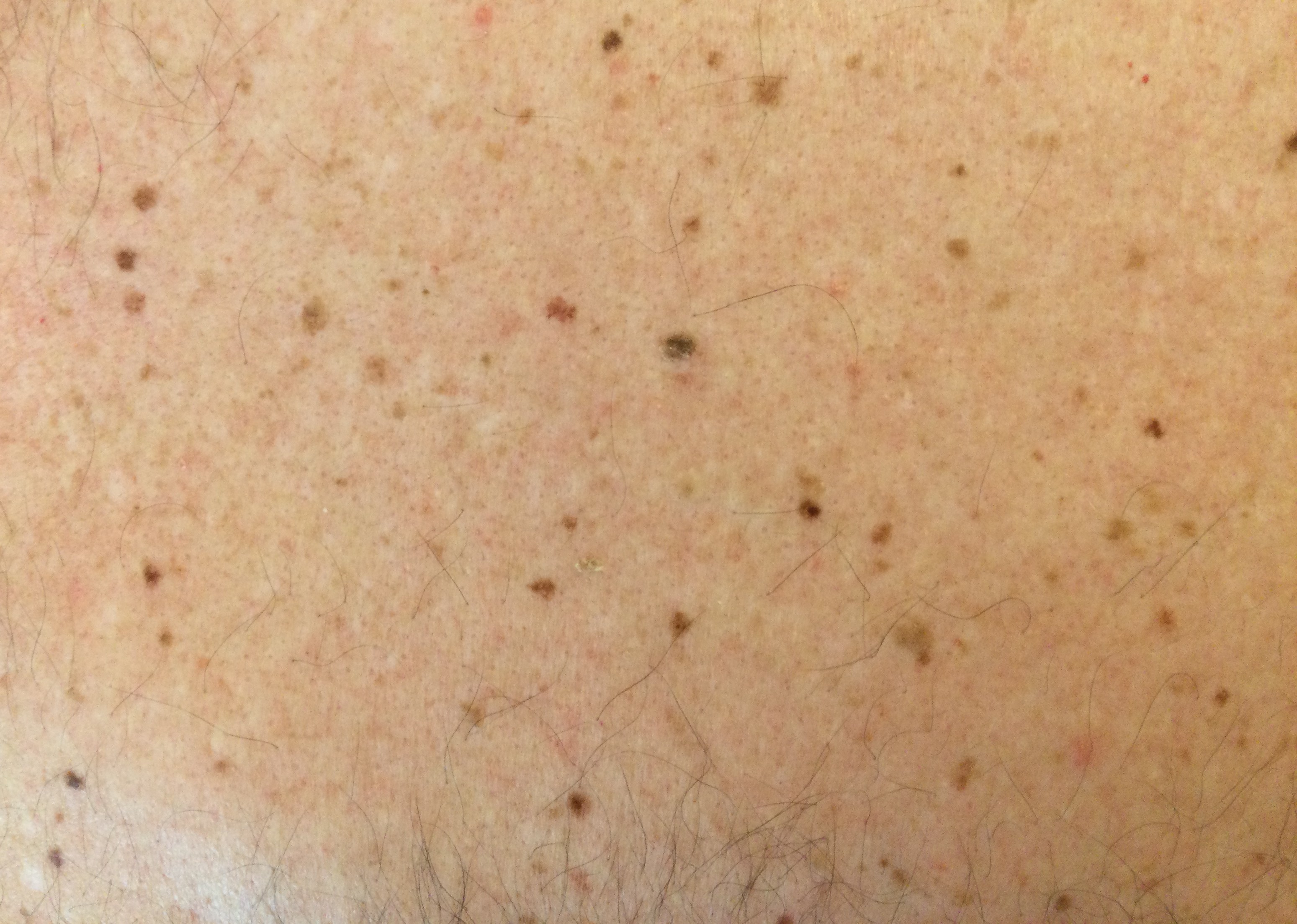 Typical benign moles