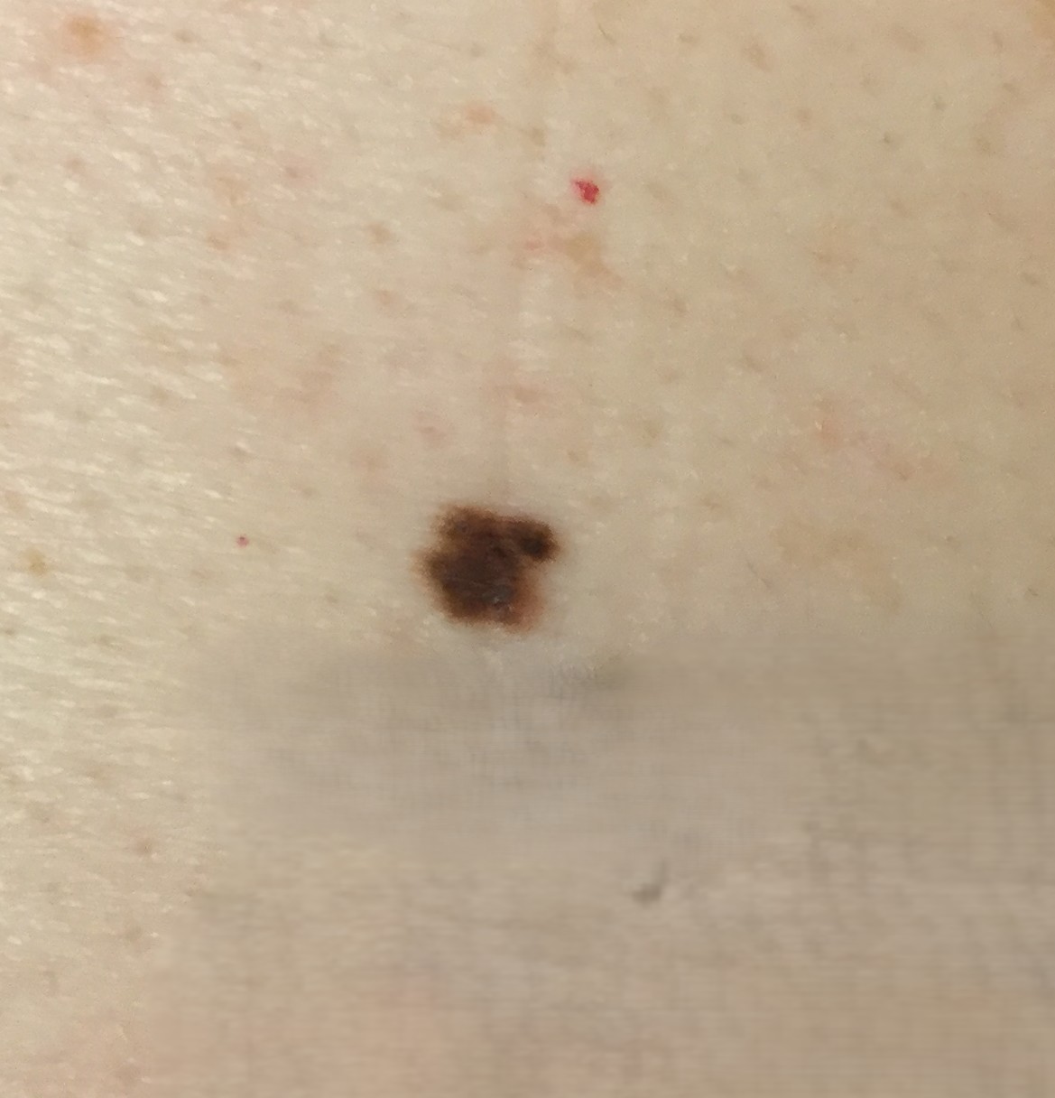 Atypical moles requiring monitoring