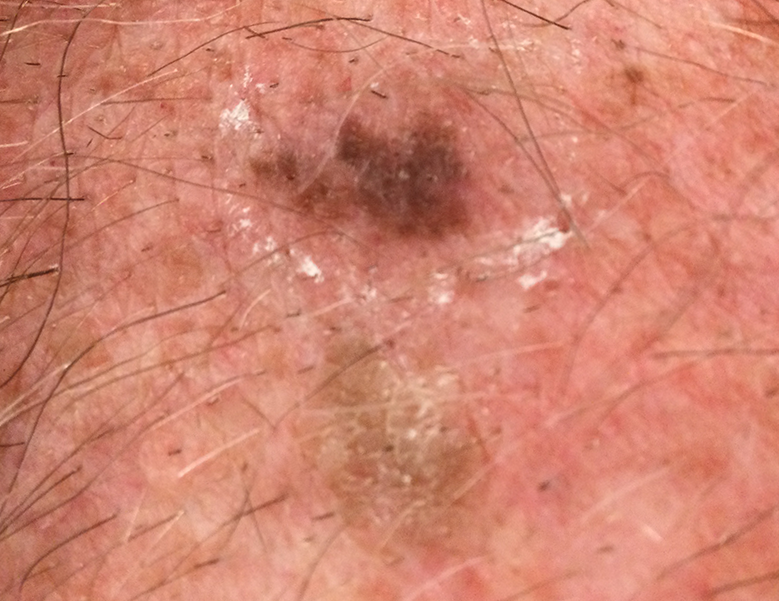 Melanoma requiring immediate attention