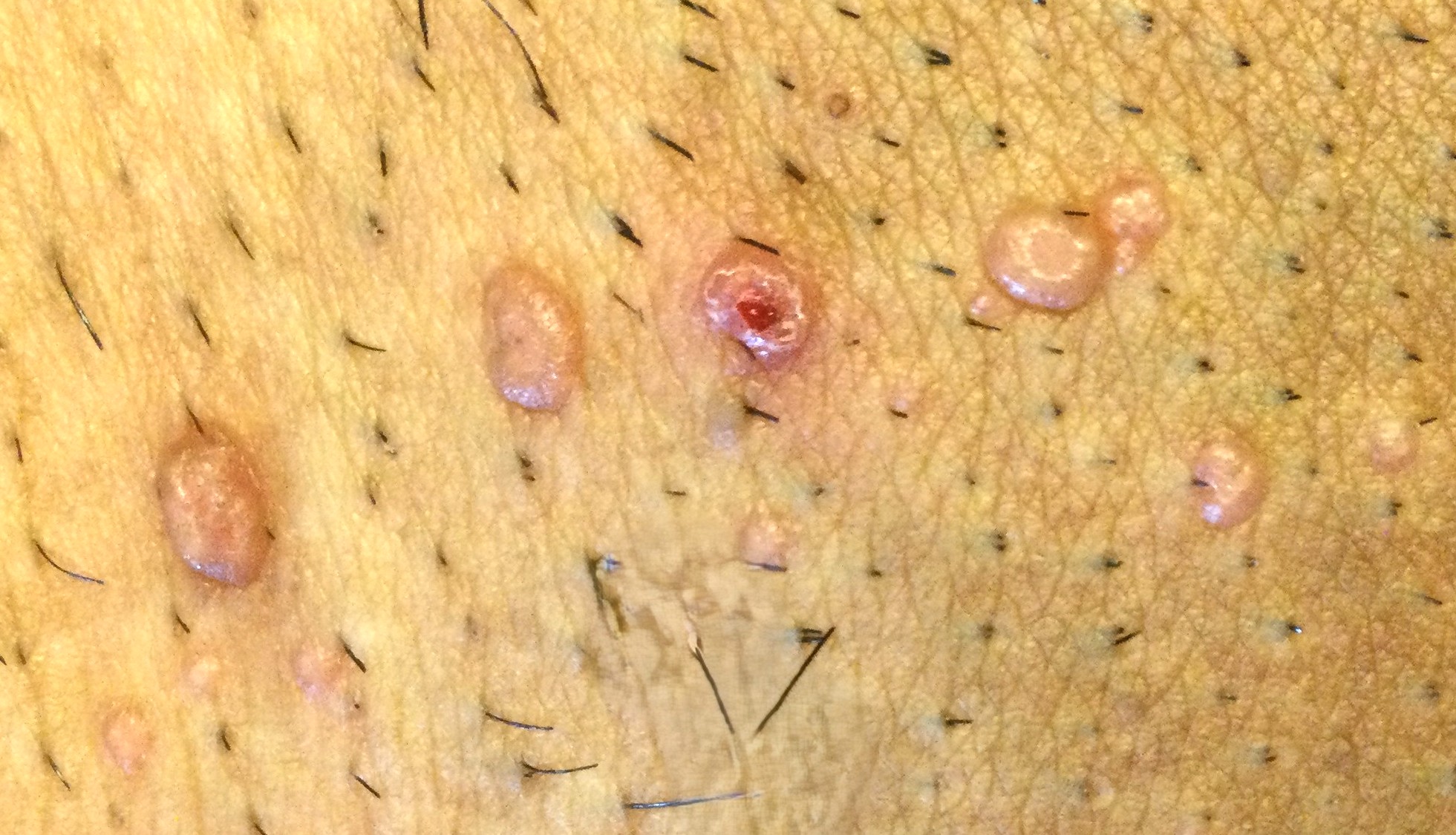 Molluscum contagiosum lesions showing characteristic appearance