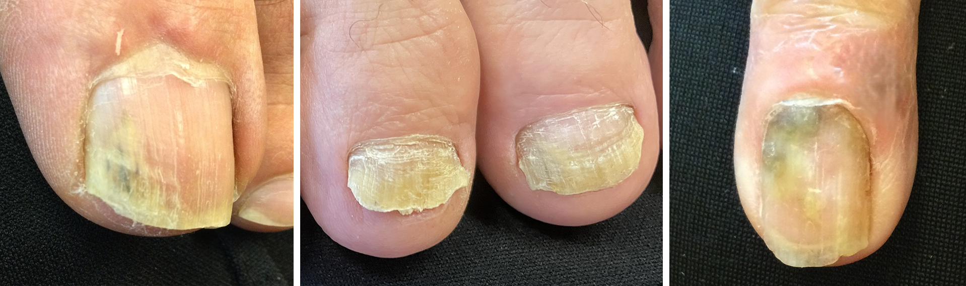 Examples of nail disorders requiring evaluation