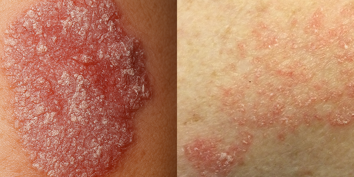Psoriasis before and after treatment showing improvement
