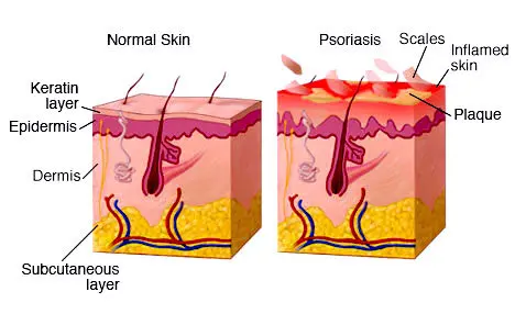 Comparison of normal skin and psoriatic skin showing plaque formation