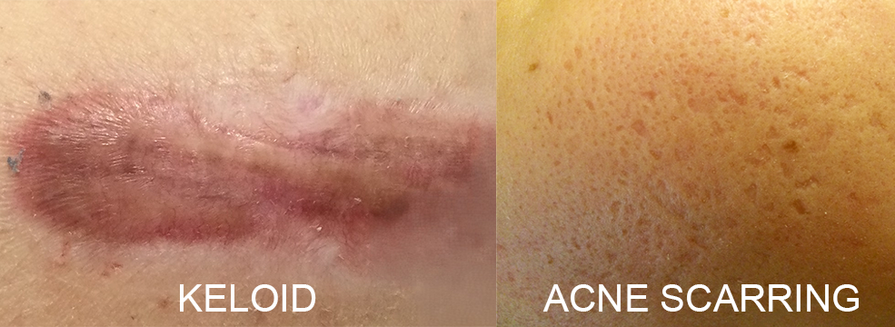 Clinical example of hypertrophic scar showing raised texture