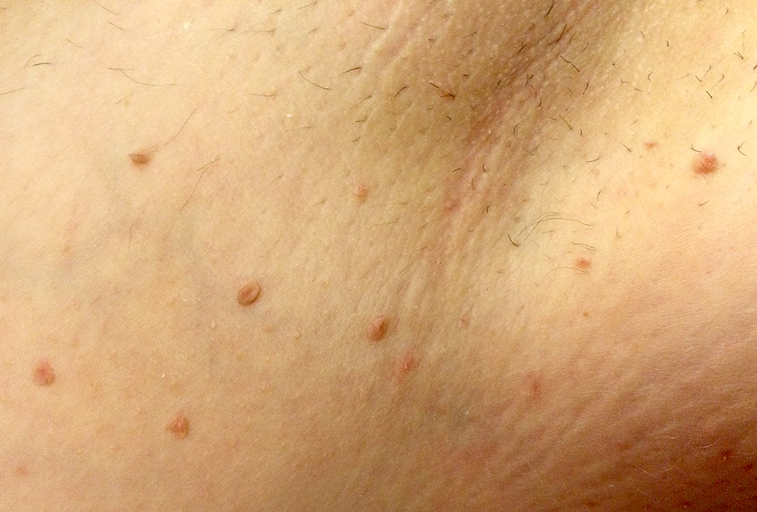 Underarm skin tags