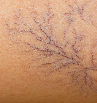 Example of spider veins on leg