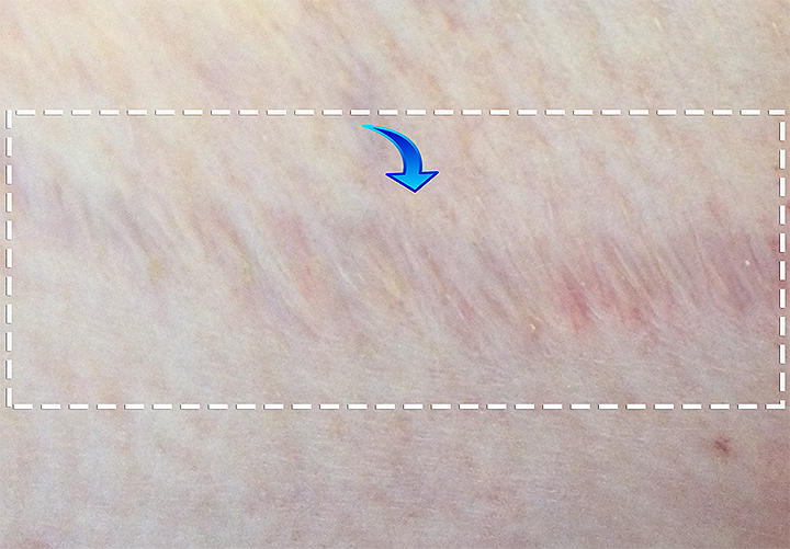Example of stretch marks showing characteristic linear pattern