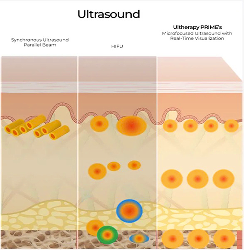 Ultherapy Penetration