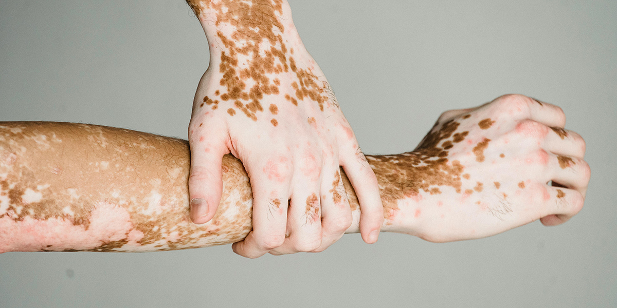 Vitiligo showing depigmented patches on hands and arms