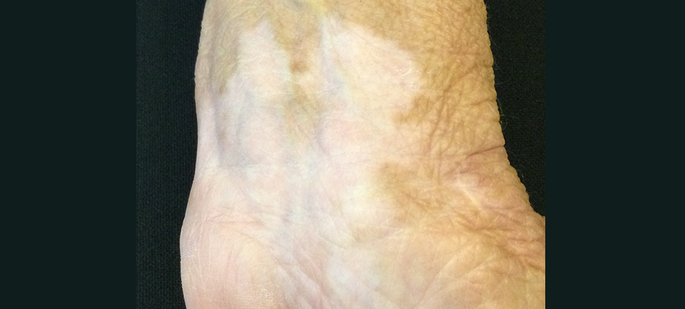 Close-up of vitiligo depigmentation on hand