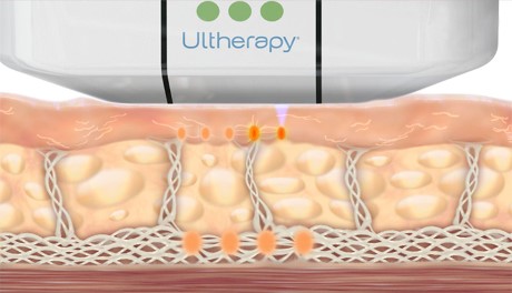 ultherapy