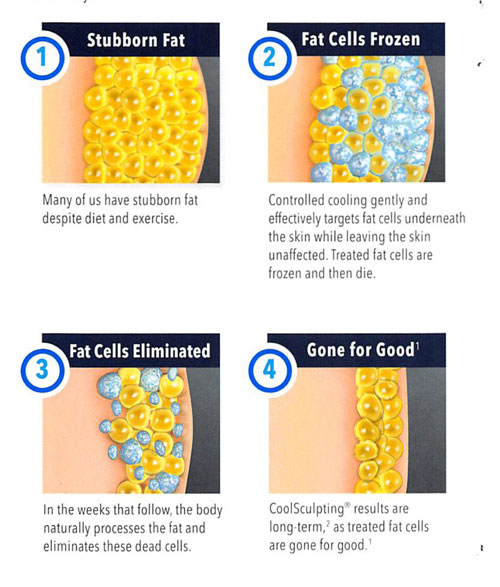 COOLSCULPTING  thesakuraclinic