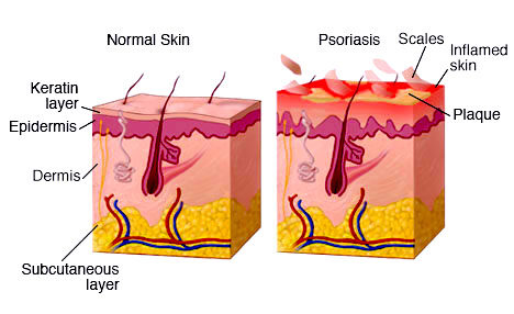 In psoriasis, dysfunctional skin cells have been activated, which causes them to produce inflammatory proteins. As a result, cells in the epidermis grow 26 times faster than normal; resulting in thick, red, scaly, raised areas of skin.