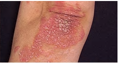 thumbnail_Elbow-Psoriasis